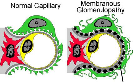 membranous glomerulonephritis spike and dome|Membranous nephropathy: current understanding of various .